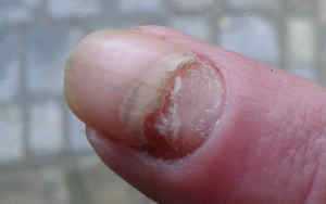 A dead finger nail